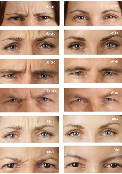 before after