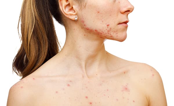 acne and scars